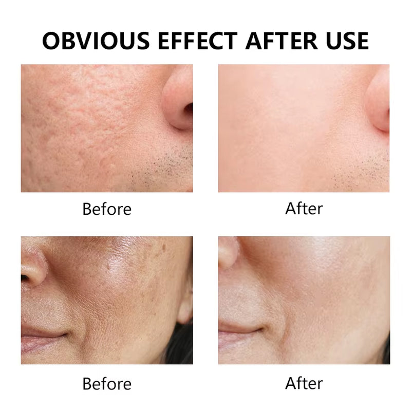 Private Label Oil Control Reduce Enlarged Pores & Dark Spots Promotes Clear Skin Tone Azelaic Acid Serum